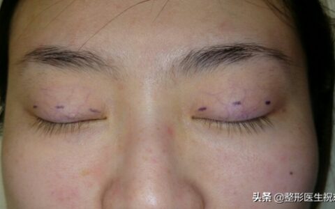 三点定位双眼皮手术,什么是三点式双眼皮？